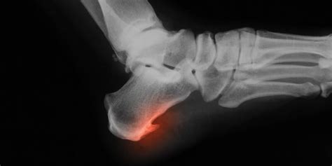bone spurs symptoms treatment   orthopedic clinic