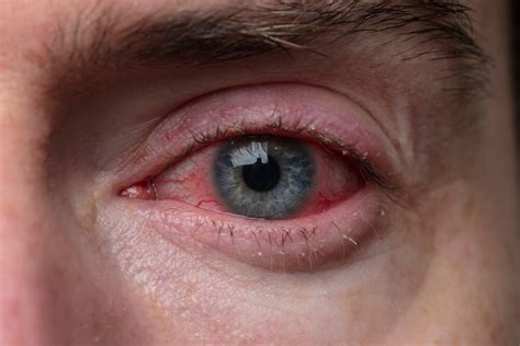 7 Recommendations To Fight Pink Eye Naturally Step To Health