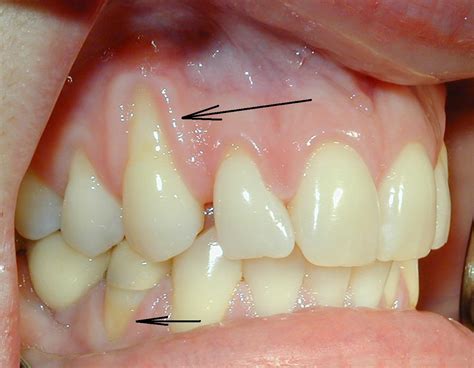 gingival recession receding gums ralev dental clinic