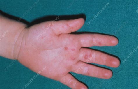 Hand Foot And Mouth Disease Skin Lesions On Hand Stock