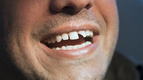broken tooth tips  handling broken teeth art  smiles