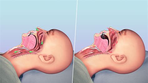 sleep apnea  symptoms  treatment scientific animations