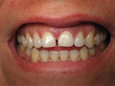 keeping a space between front teeth bridge vs dental