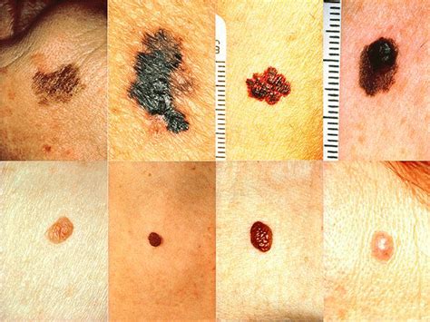 Melanoma Health24