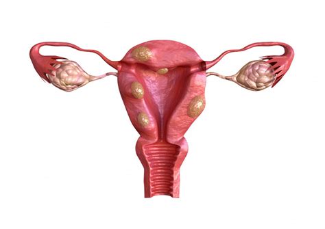 vaginalna intraepitelna neoplazija udruzenje porodica sa problemom steriliteta bebe