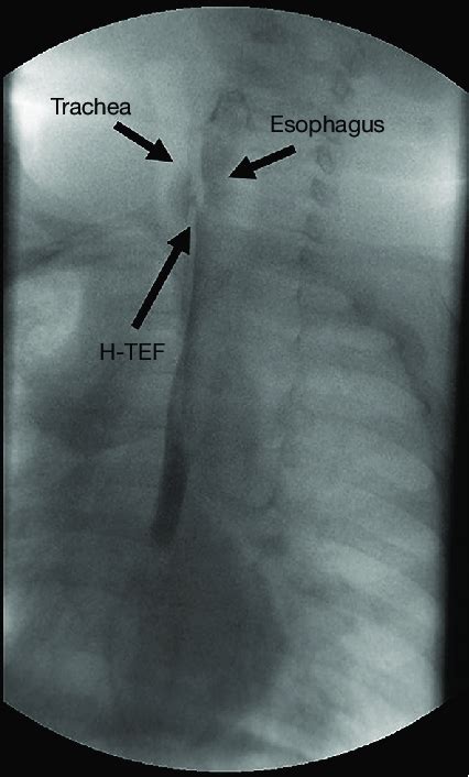 Video Esophagography Image Showing An H Type Tracheoesophageal Fistula
