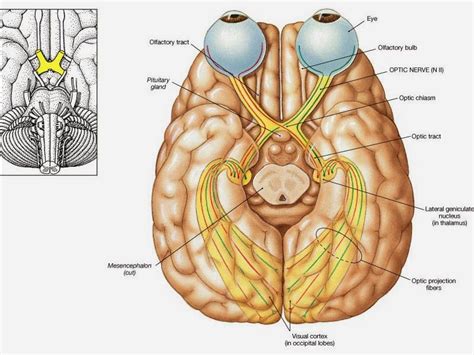 optic nerve hypoplasia    part  optic