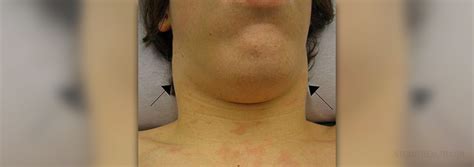 swollen lymph nodes  children general center steadyhealthcom