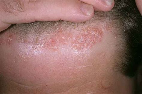 Seborrheic Dermatitis Seborrhea Symptoms And Treatment Health