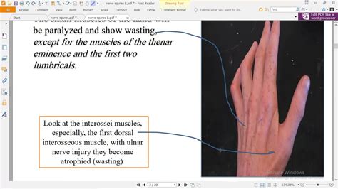 anatomy medical students lecture  part  ulnar nerve injury youtube