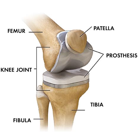 total knee replacement orthopedic specialty clinic spokane wa