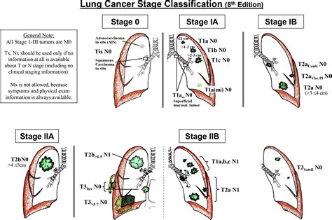 eighth edition lung cancer stage classification chest