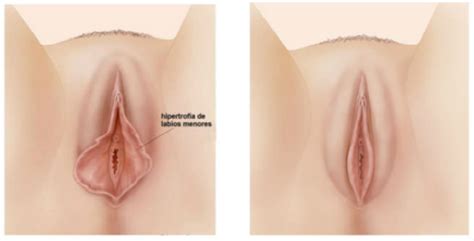 Vaginal Rejuvenation Procedures Results Recovery Time