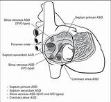 Septal Atrial Types Defects Asd Defect Ventricular Atrioventricular Svc Ivc Locations Superior Anatomic Inferior Figure sketch template