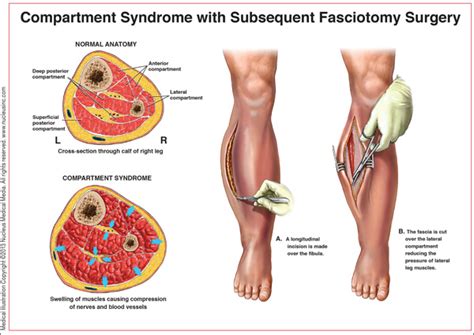 acute compartment syndrome to save a limb clinician reviews
