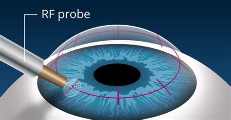 conductive keratoplasty ck reduces need for reading glasses