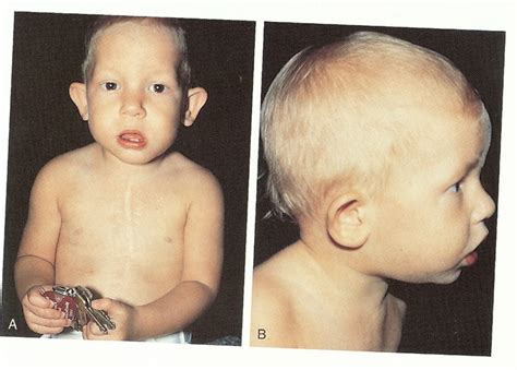 medical pictures info digeorge syndrome