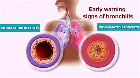 bronchitis prevention how to get rid of bronchitis without antibiotics