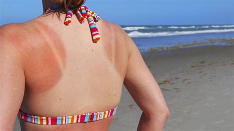 5 Sunburn Treatments To Save Your Vacation Everyday Health