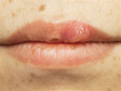 Hiv Mouth Sores Pictures Causes Treatment And