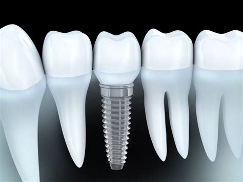 discover  cost  colorado springs dental implants