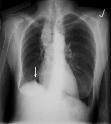 Juxtaphrenic Peak Sign Frontal Radiograph Of The Chest Shows A