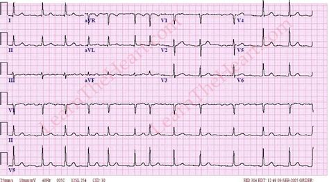 Atrial Fibrillation With Normal Ventricular Rate Example 3
