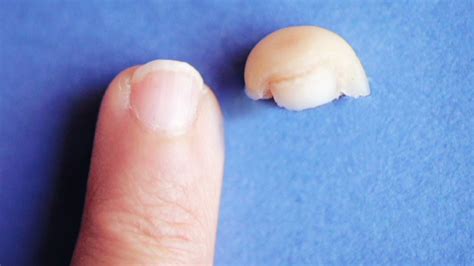 Woman S Persistence Pays Off In Regenerated Fingertip