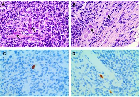 protracted primary cytomegalovirus infection presenting as ileoanal pouchitis in a non