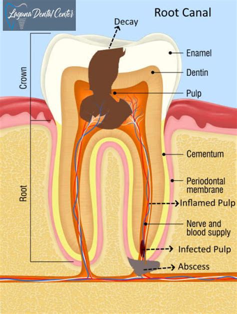 dental cavity procedure    turn   procedure