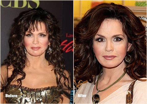 Marie Osmond Plastic Surgery Before And After Photo 2013