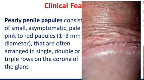 pearly penile papules a common disturbing complaint youtube