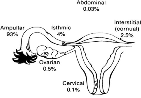 modern management  cornual ectopic pregnancy semantic scholar