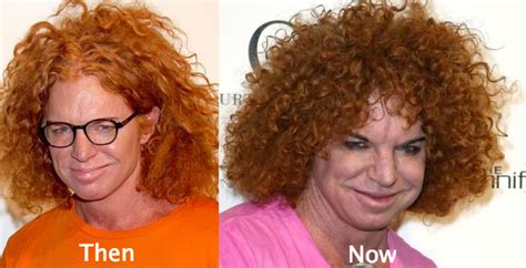 53 Celebrity Plastic Surgery Gone Wrong With Photos