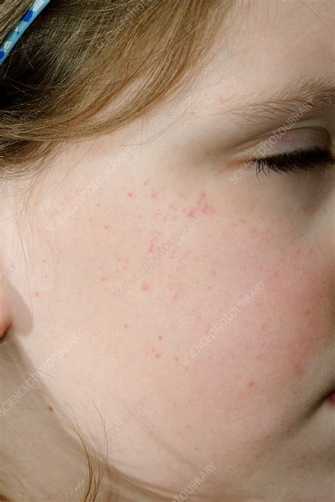 petechial rash  young girls face stock image  science photo library