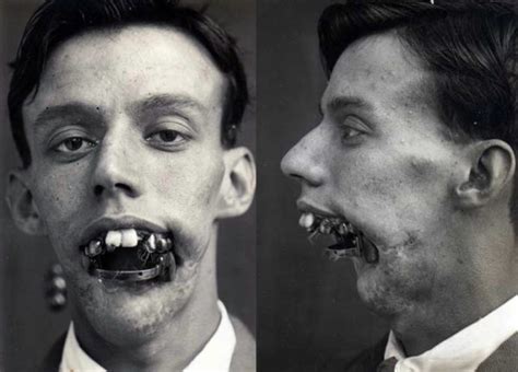 plastic surgery in world war i 10 photos klyker