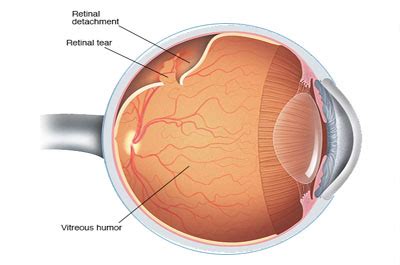 retina ophthalmologist eye physician surgeon