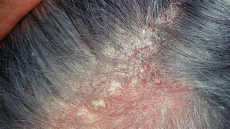 How Eczema And Other Skin Disorders Affect Hair Maxim Hair Restoration