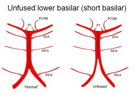 human anatomy variation  fusion patterns   basilar artery