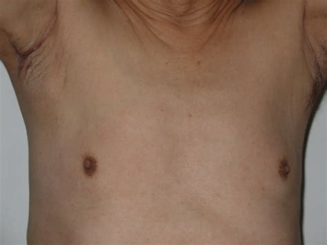 Figure 1 Axillary Metastasis As The First Manifestation Of Male Breast