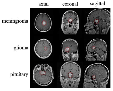 applied sciences  full text classification  brain tumors