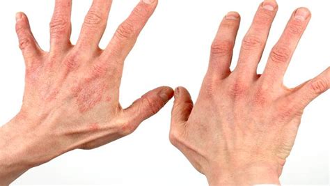 10 home remedies for dermatitis on hands and on face