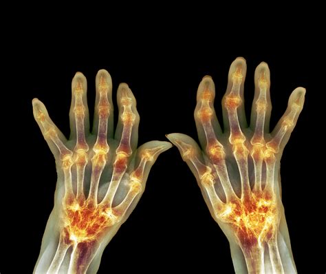 case study cardiac manifestations  rheumatoid arthritis