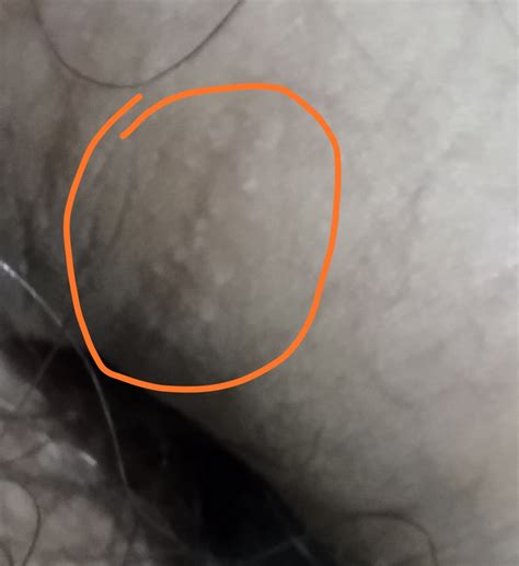 Small Bumps On Shaft Sexual Health Forums Patient