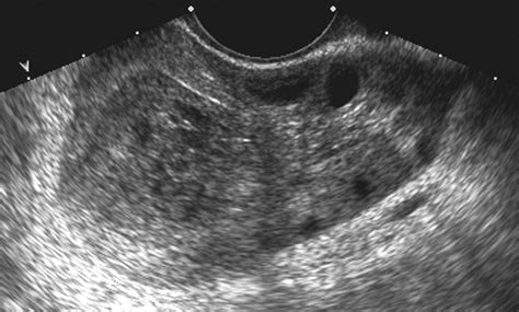 ovarian torsion ultrasound appearance  xxx hot girl