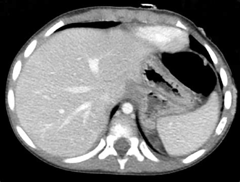Abdominal Ct Showing The Normal Position Of The Liver With The Patient