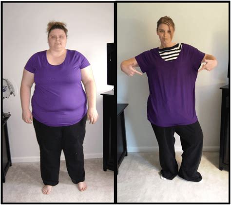 Gastric Bypass Before And After Pictures And How Life Will
