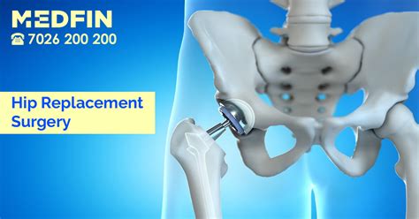 hip replacement surgery      medfin