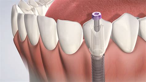 full dental implants cost dentist rockville md