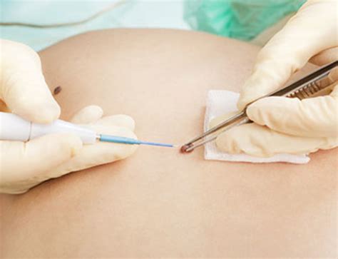 post liposuction cannula scar laser removal treatment eve